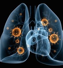 Pneumonia: Causes, Symptoms, and Comprehensive Insights into Treatment and Prevention