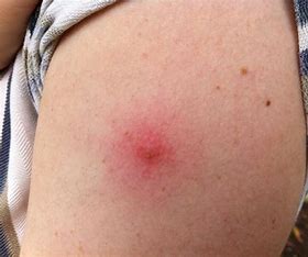 Side Effects and Vaccine Injuries After COVID Vaccination - What Affected Individuals Need to Know